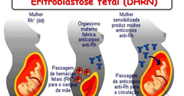 Biologia 2°M04 : DHRN (Doença Hemolítica do Recém-Nascido)