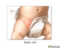5 HOME REMEDIES FOR DIAPER RASH 5 HOME REMEDIES FOR DIAPER RASH
