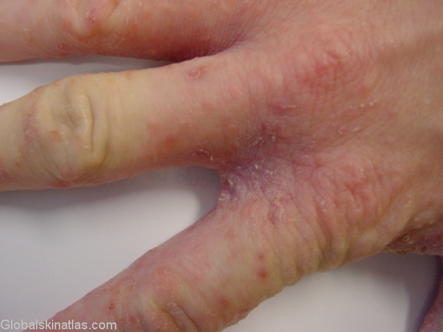What Are the Treatments for Genital Scabies? | eHow