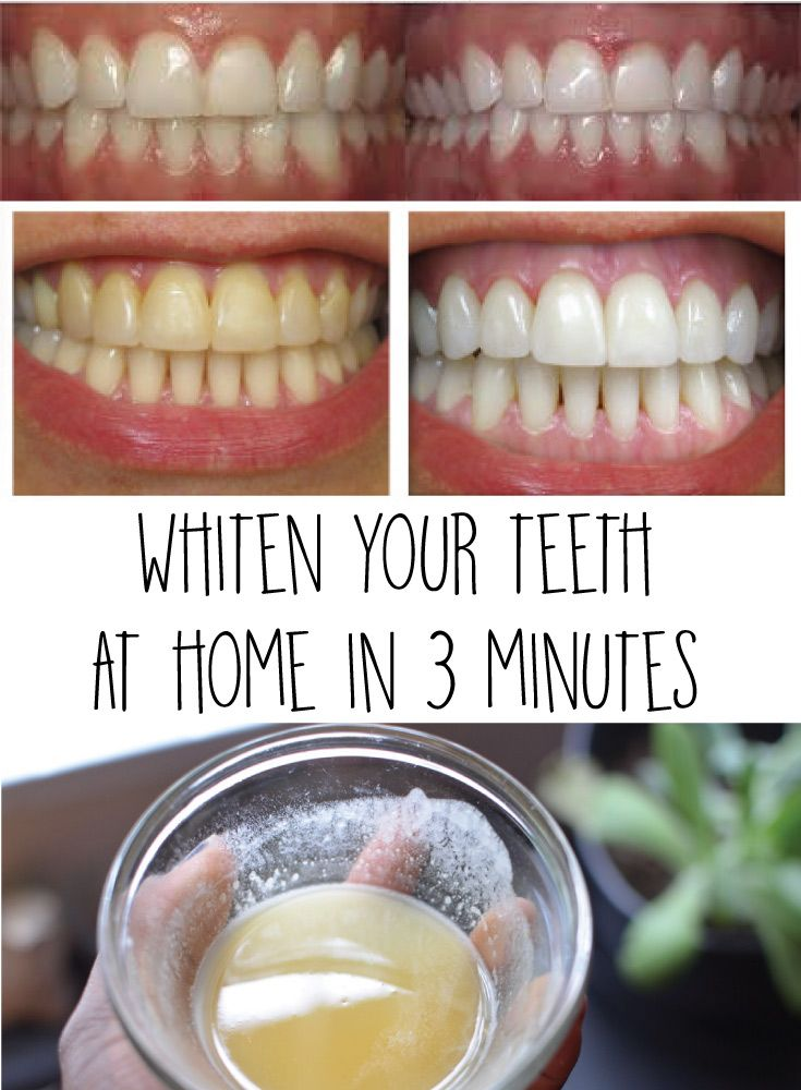 Whiten your teeth at home in 3 minutes Health Fitness