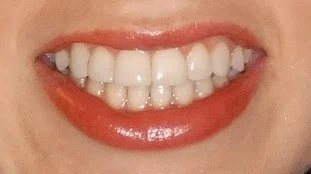 orthodontic after photo