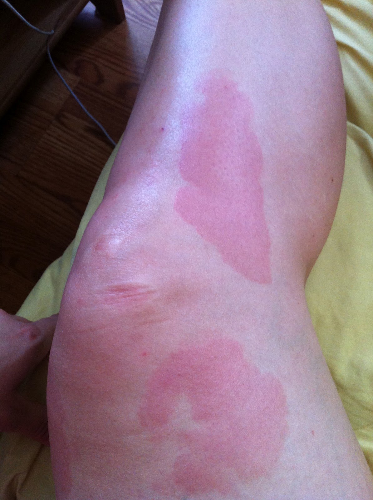 Banter from Brooklyn Ice Pack Burn