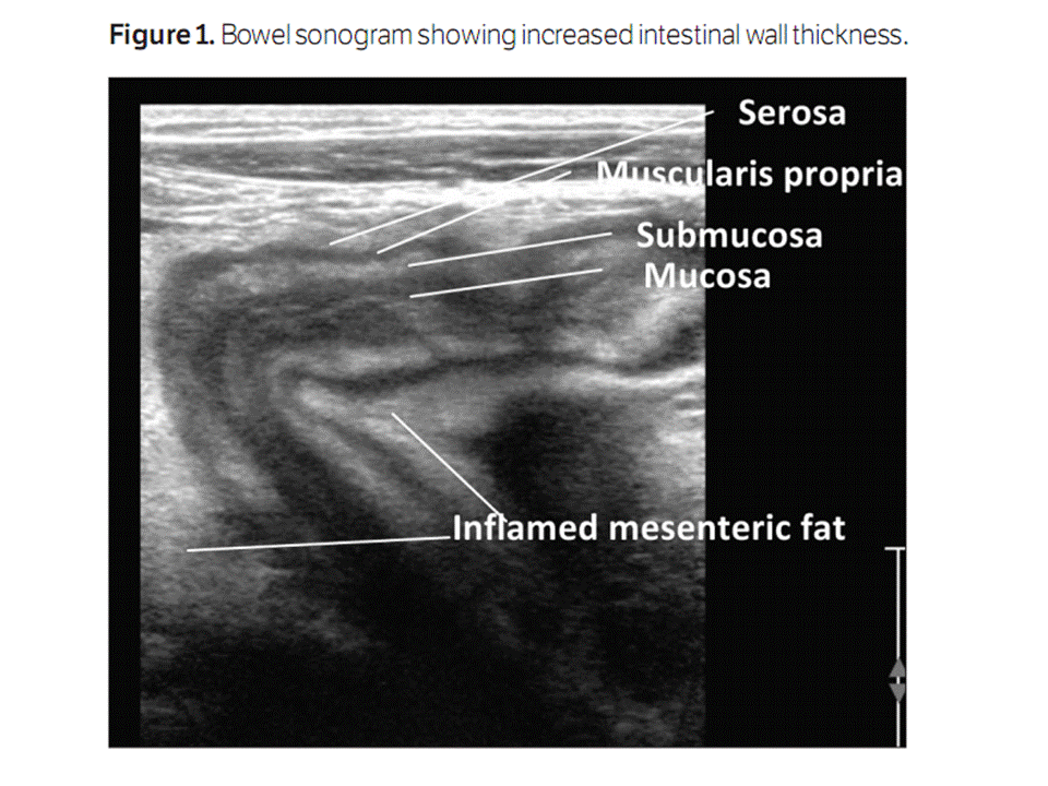 BÀI SOẠN VỀ SIÊU ÂM CHẨN ĐOÁN IBD and ULTRASOUND