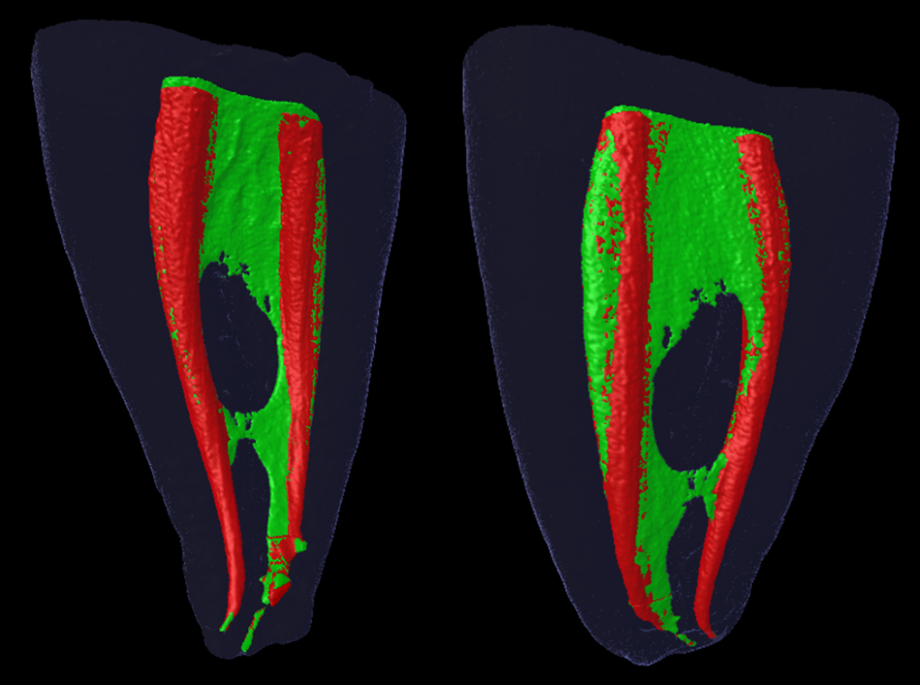 3 корневых каналов. Система корневых каналов зуба. Анатомия каналов зубов эндодонтия. Сложная анатомия корневых каналов.