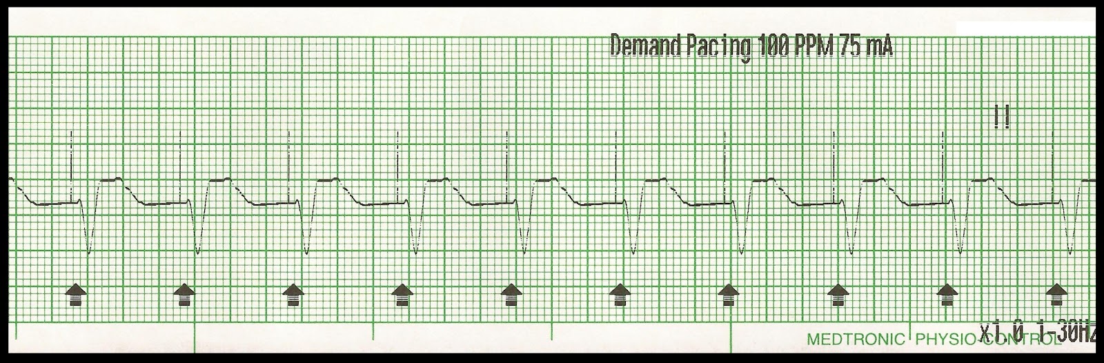 Unstable Bradycardia Part 3