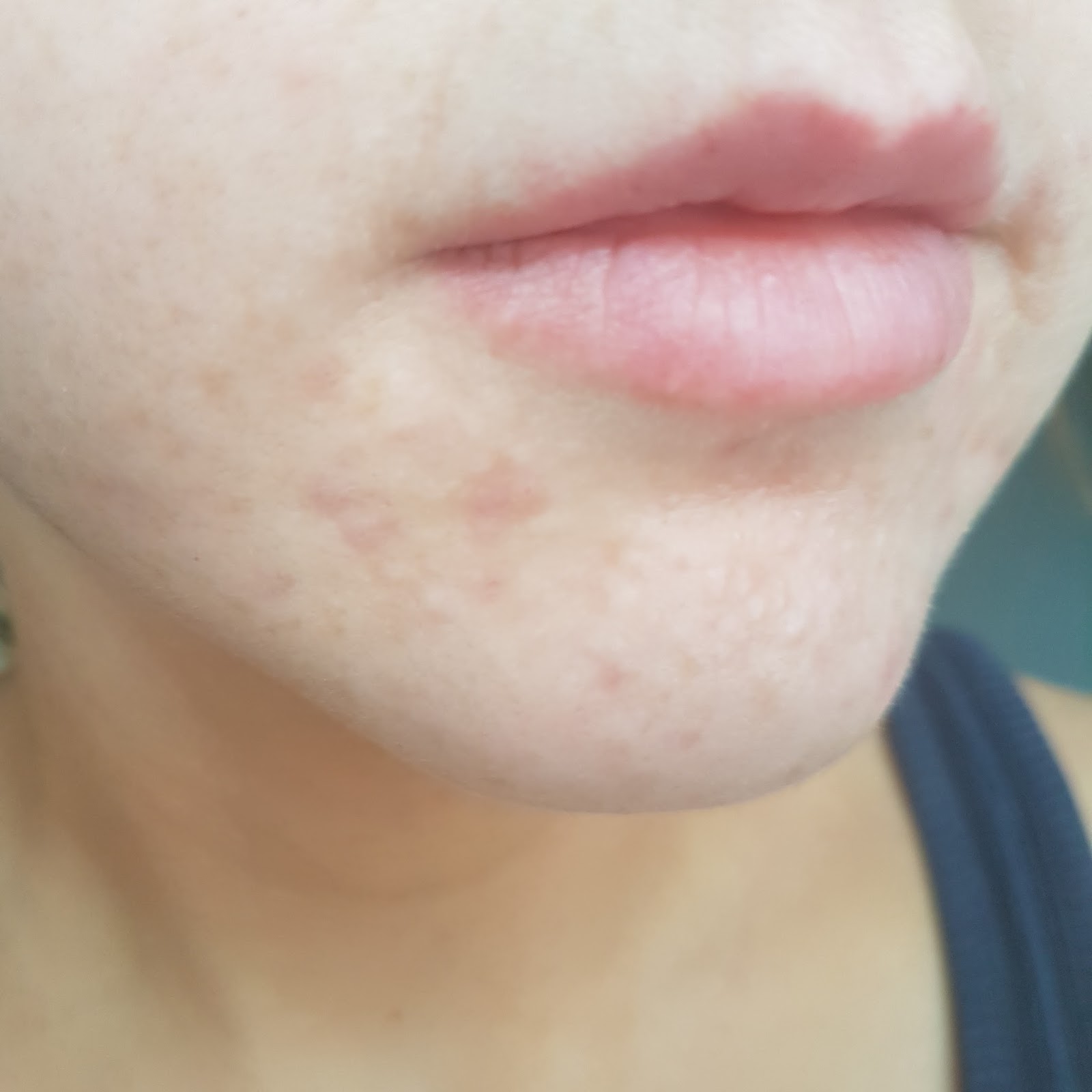 can dairy cause acne around mouth