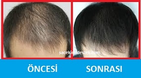 saç mezoterapisi öncesi ve sonrası 29