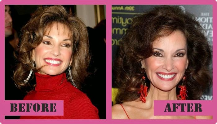 Susan Lucci Plastic Surgery.