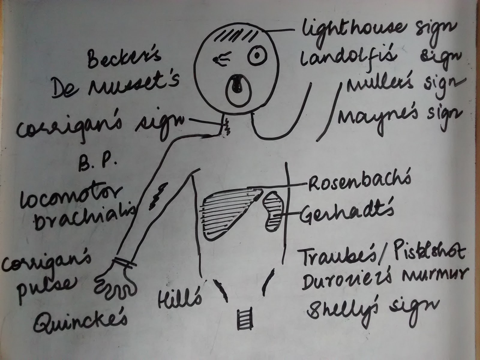 by-pulsatile-peripheral-signs-in-aortic-regurgitation