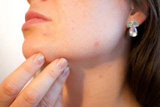 Information on acne control