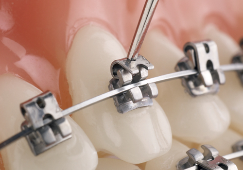 lợi ích của việc niềng răng lợi ích của việc niềng răng