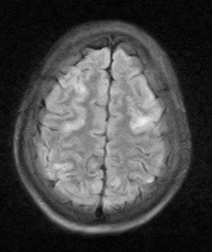 Posterior Reversible Encephalopathy Syndrome (PRES) Sumer #39 s Radiology Posterior Reversible Encephalopathy Syndrome (PRES) Sumer #39 s Radiology