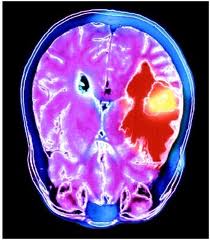 mri scan images of brain tumor Photos real pictures color