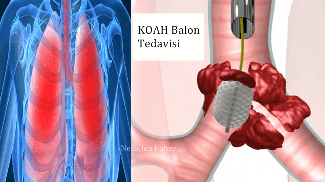 koah balon tedavisi nedir nasil yapilir