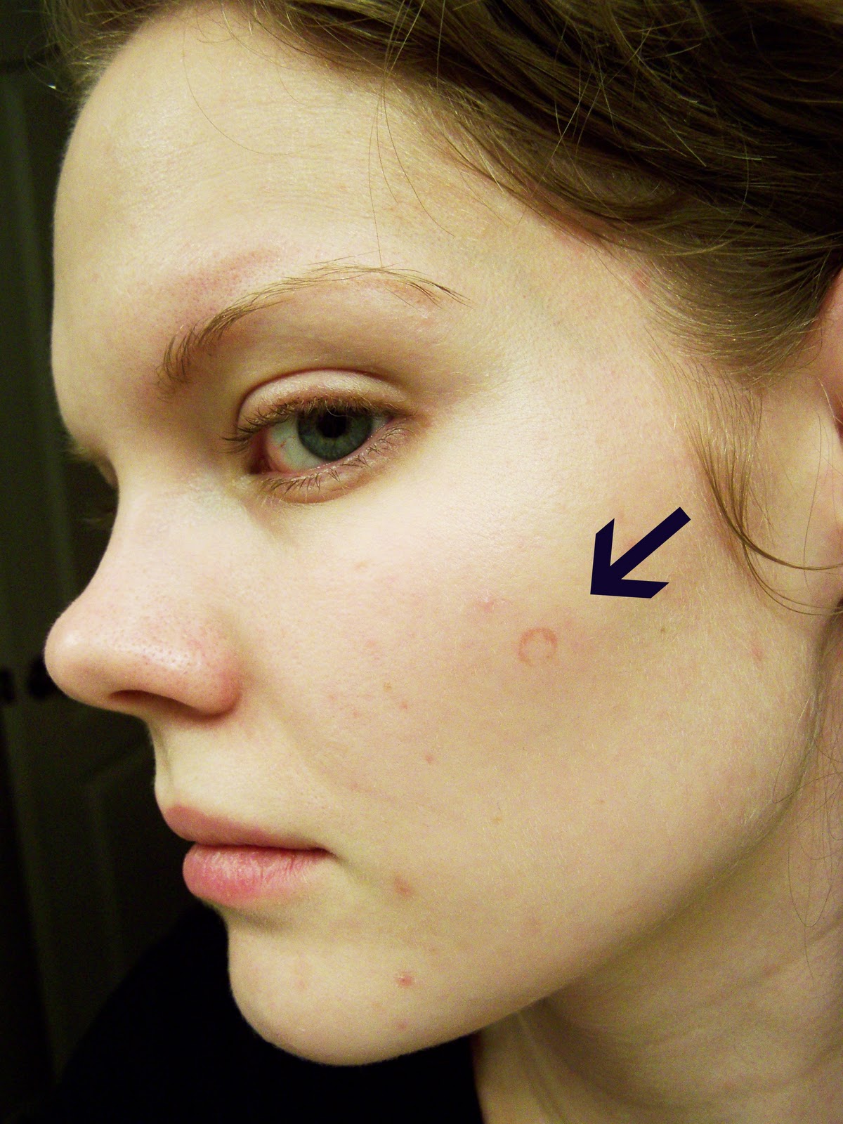 pictures of ringworms on face
