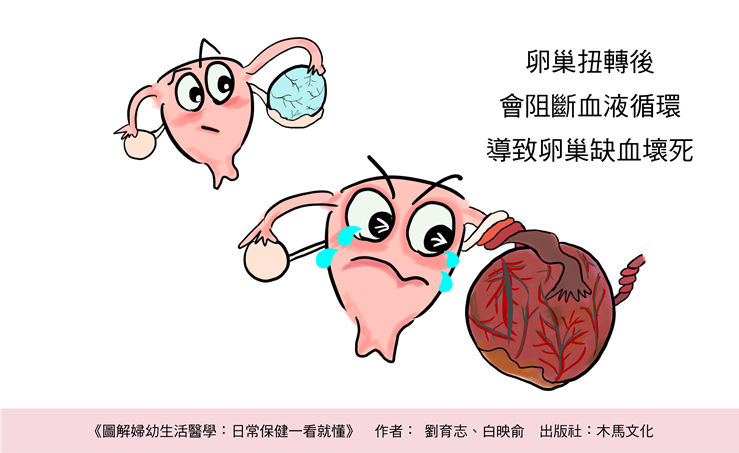 卵巢扭轉-照護線上 卵巢扭轉會導致卵巢缺血壞死