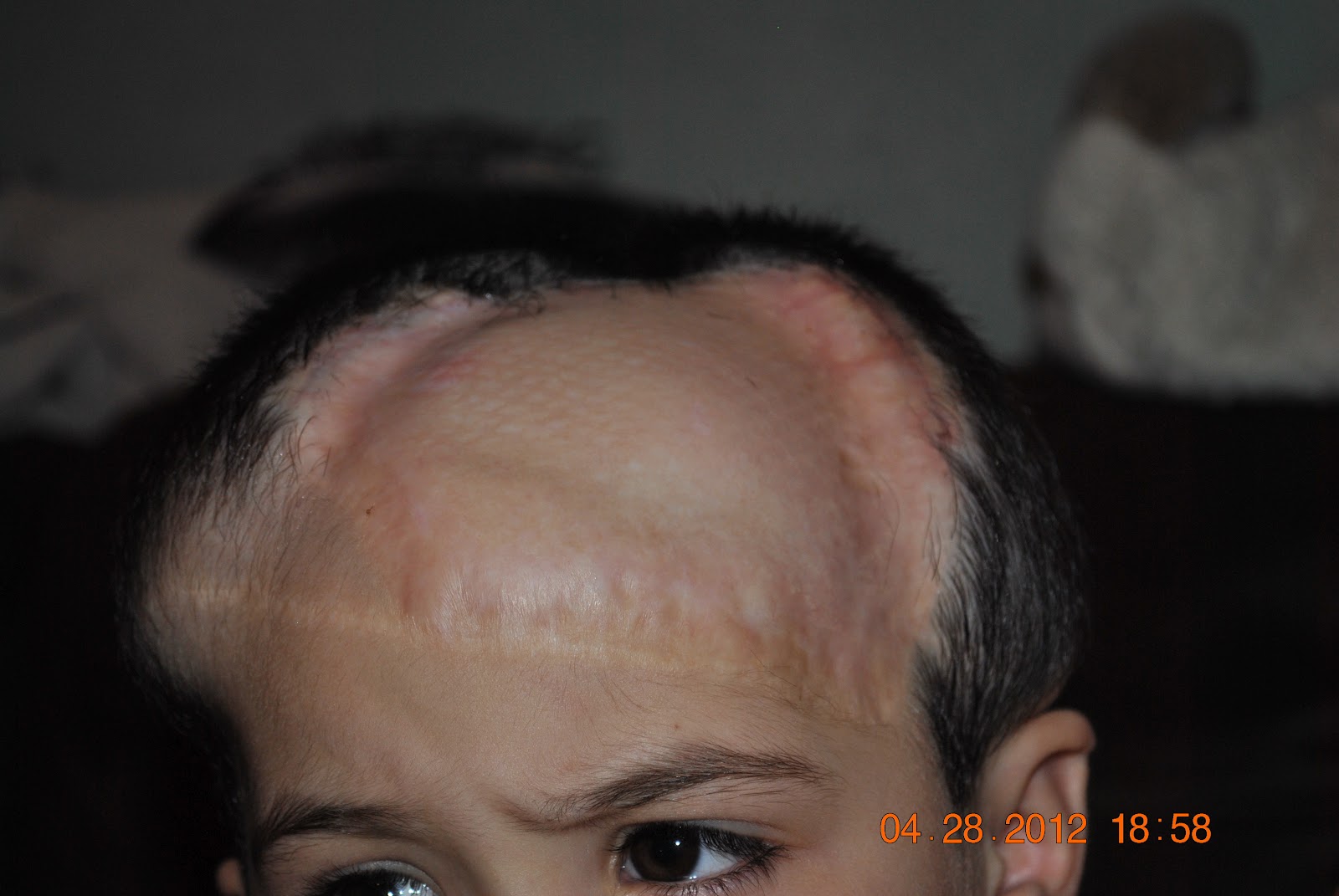 Age 4 Female Scalp Tissue Expanders Third Filling