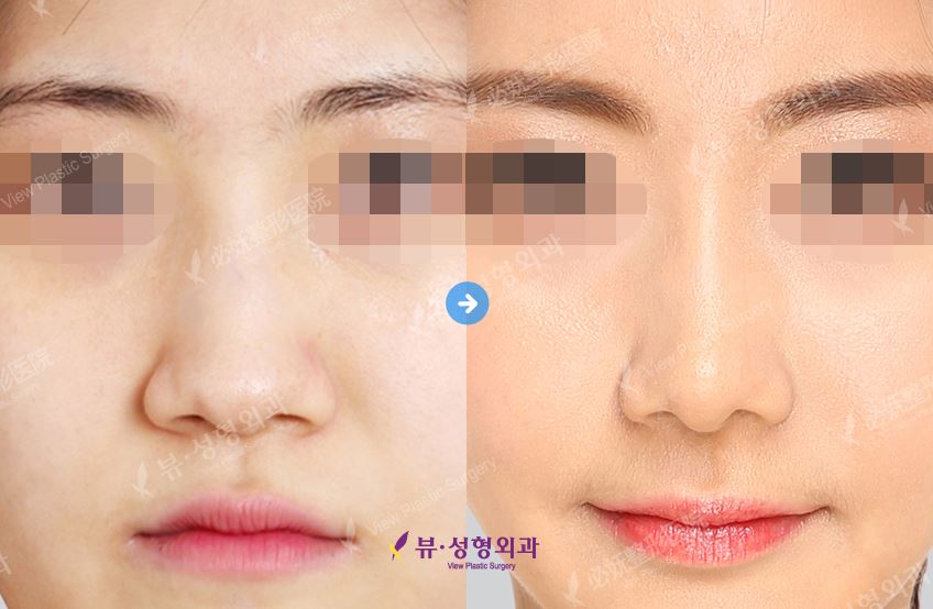VIEW Plastic Surgery Korea Rhinoplasty for a wide nose