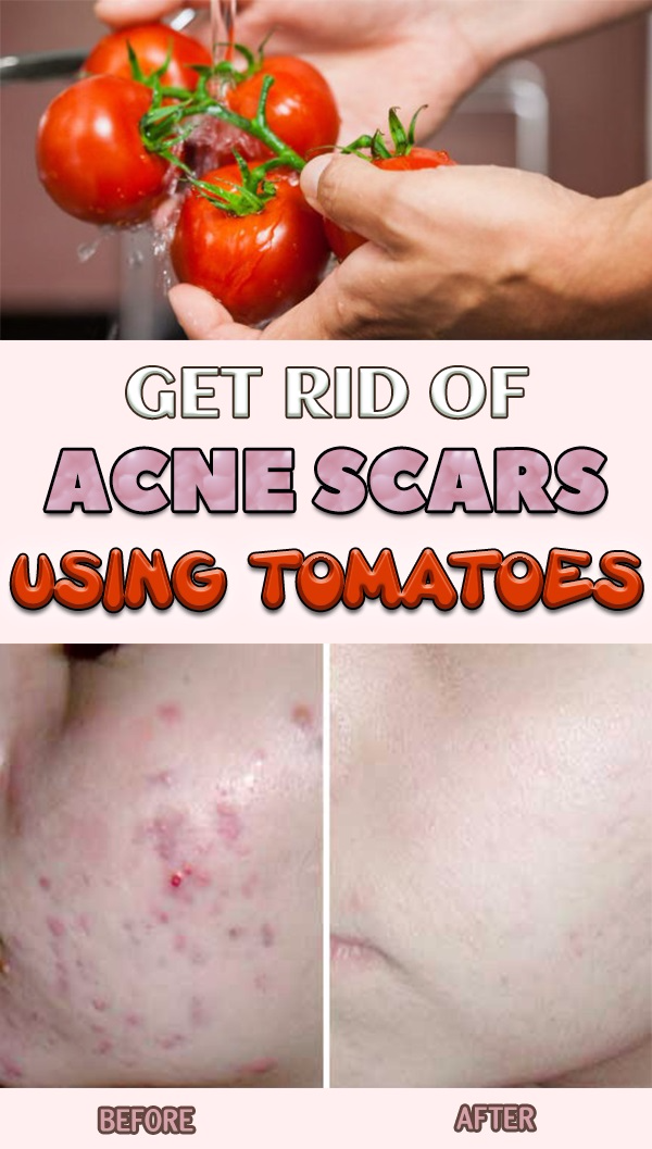 GET RID OF ACNE SCARS USING TOMATOES HEALTHYLIFE
