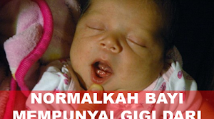 Kejadian langka, baru lahir sudah mempunyai gigi. Apakah normal?