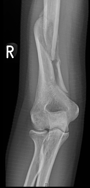 Spiral Fracture X Ray
