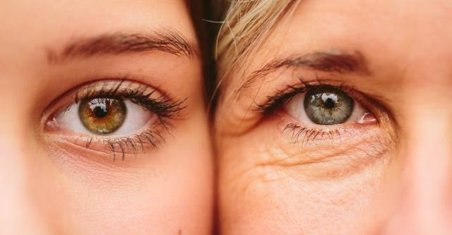 How to Get Rid of Wrinkles Around the Eyes Naturally