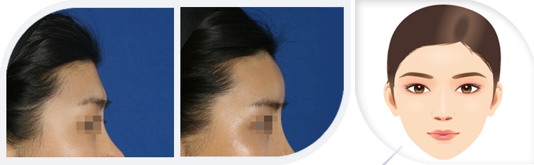 BK Plastic Surgery: [BK Plastic Surgery] Facial bone contouring