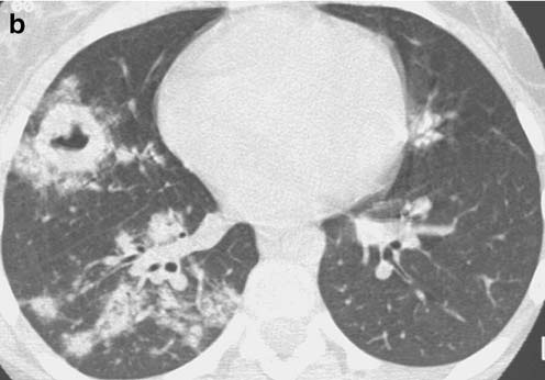 Radiología en la granulomatosis de Wegener infantil
