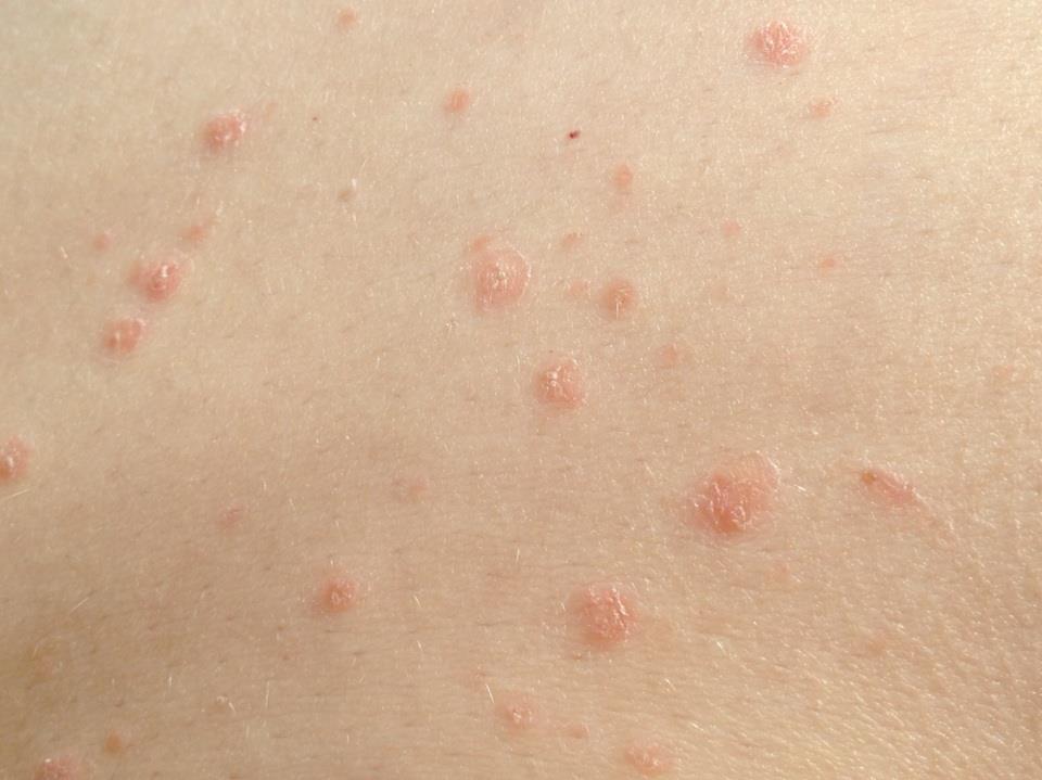 rash on sides of stomach