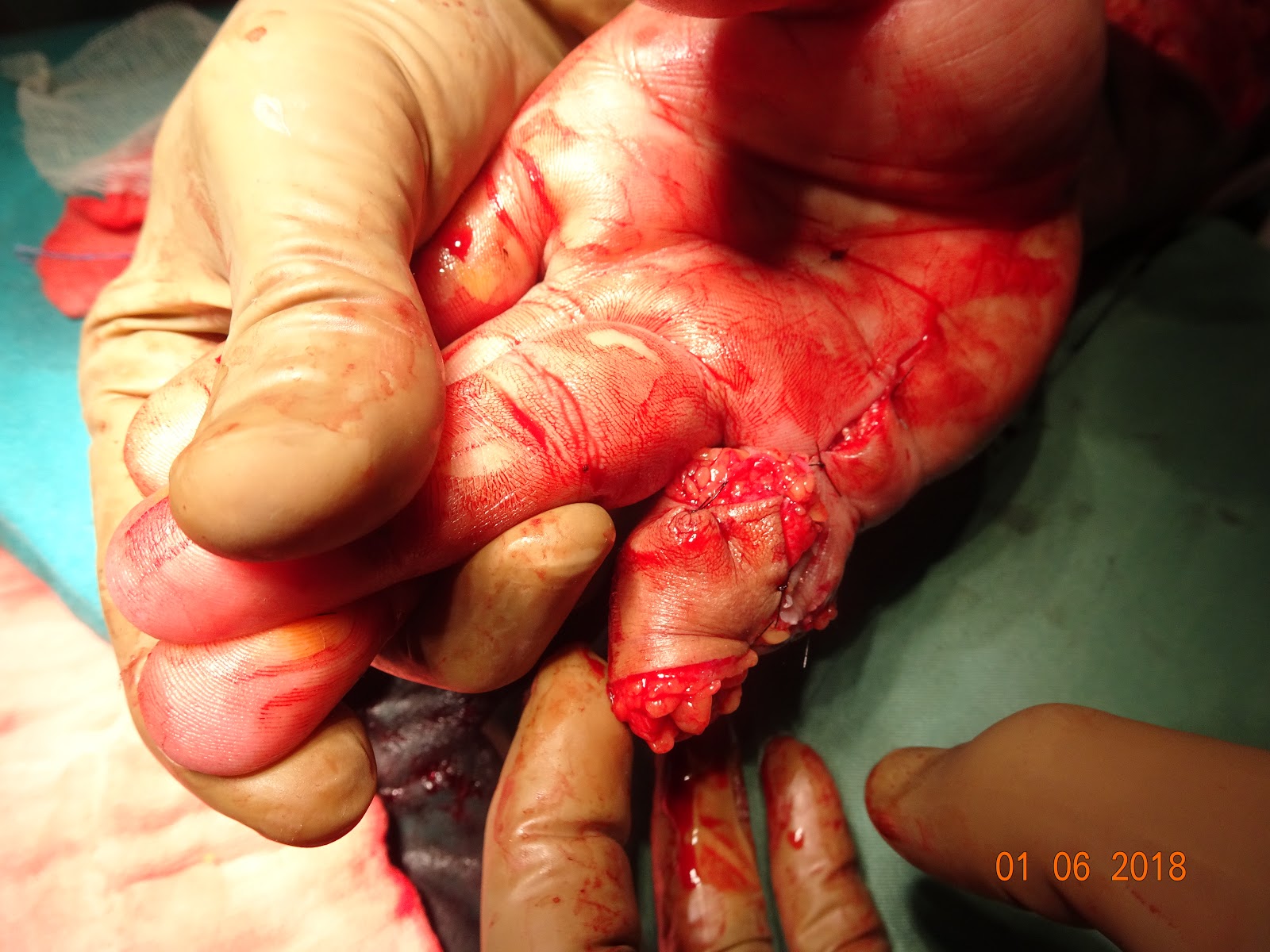 Arterilized venous flap fo finger degloving injury.