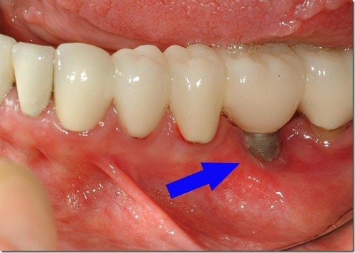 CẮM GHÉP IMPLANT KHÔNG ĐÚNG QUY TRÌNH VÀ NHỮNG BIẾN CHỨNG -2