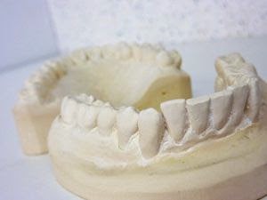 Options de remplacement des dents