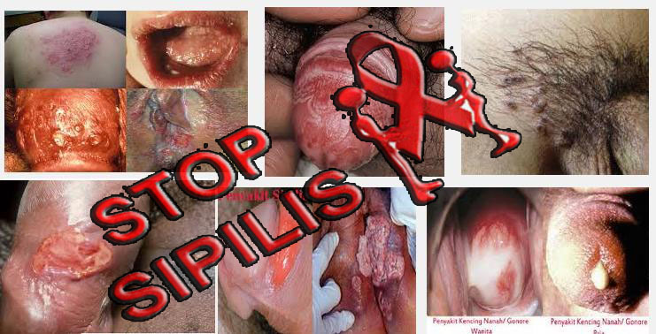 Ciri-Ciri Penyakit Sipilis Atau Raja Singa | Obat Sipiilis Herbal