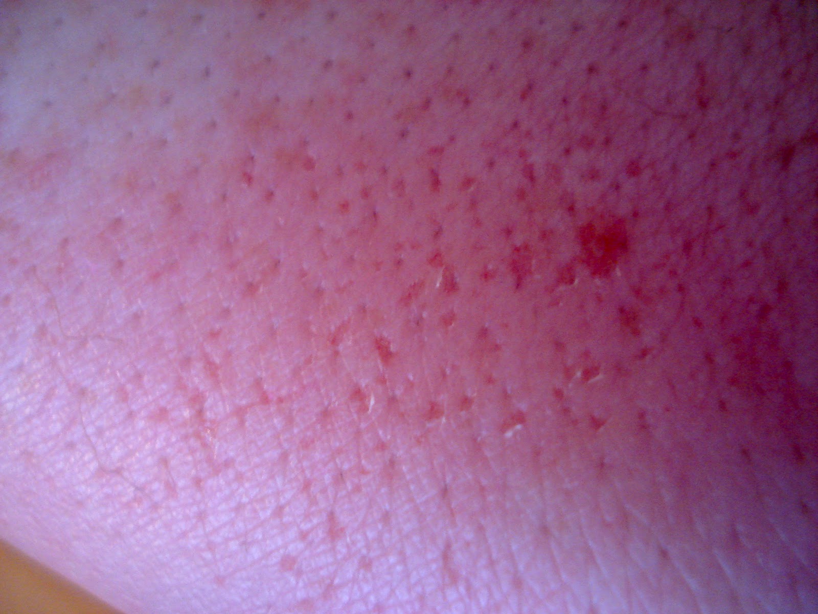 Hair Removal The Bain of my Life!