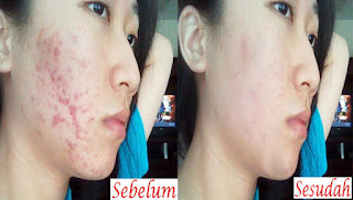 Menghilangkan Jerawat