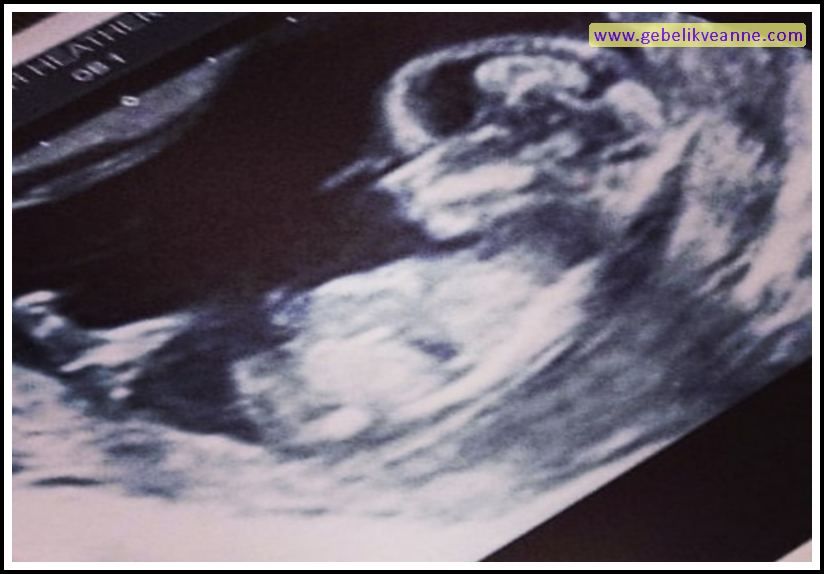 20 Haftalık Gebelik (Hamilelik) Ultrason Görüntüleri