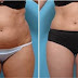 5 Exciting Pros In Relying Into Smartlipo