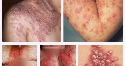 Obat Alami Ampuh: cara mengatasi bekas herpes
