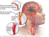Obat Stroke Parah Obat Stroke Parah