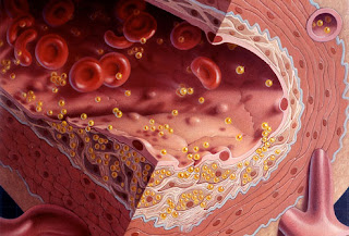 kolesterol terdiri dari HDL, LDL dan Trigilserida