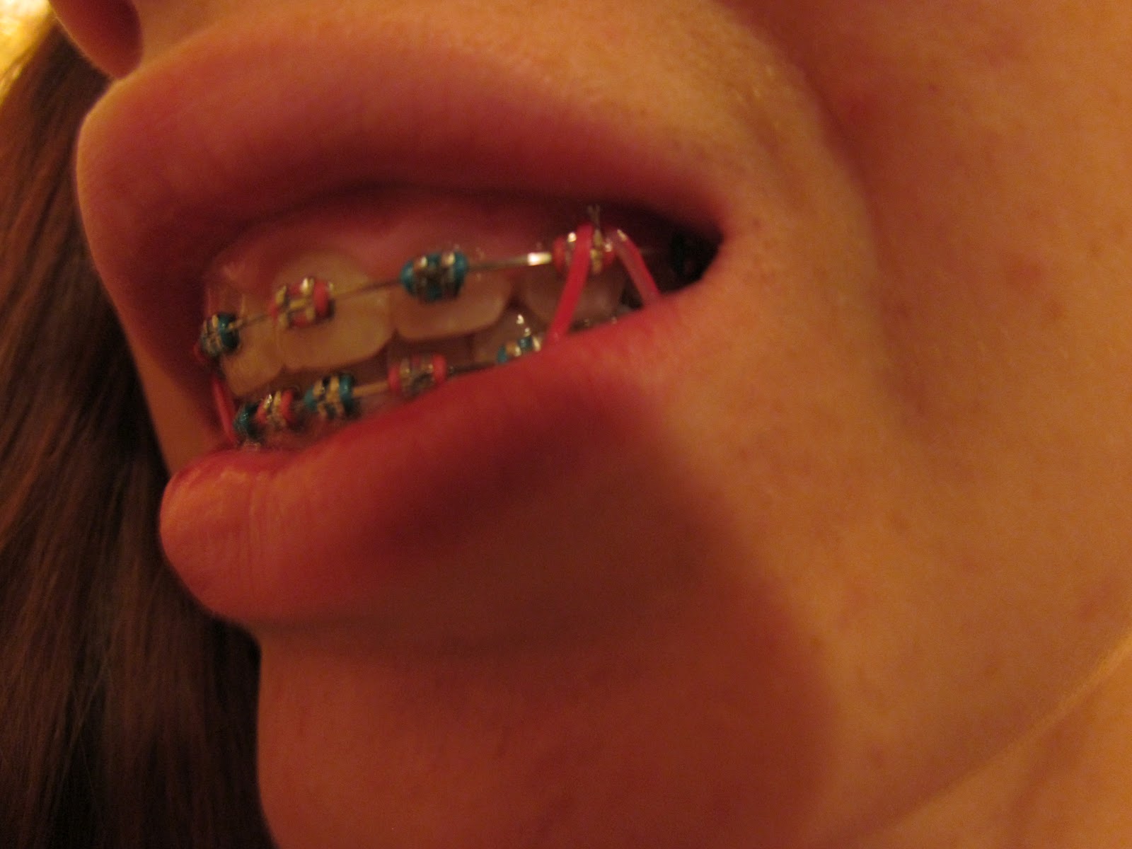 The Melody of Me Braces.... can you relate?