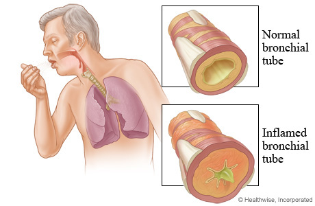 bronchitis chest again pain