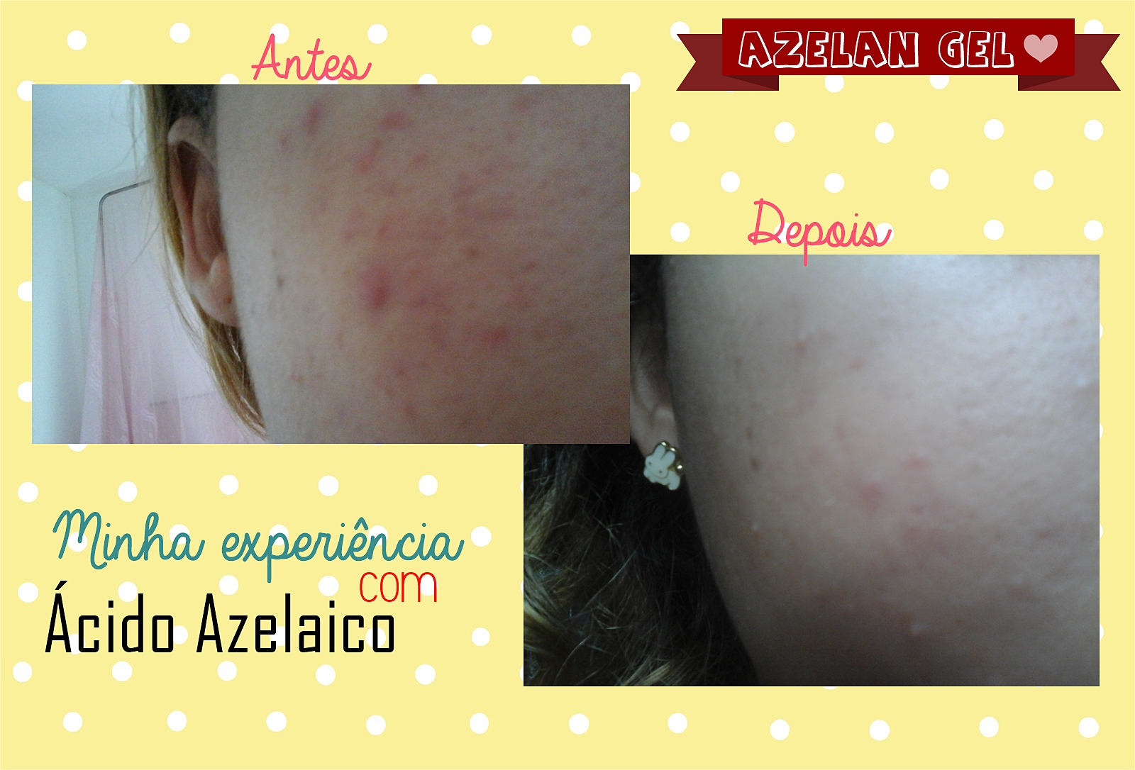 Ácido Azelaico: Antes e Depois