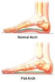 Flat feet (Pes Planus)(Fallen Arch): ~ Anatomy for MSP
