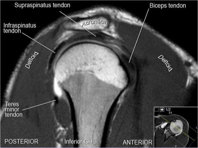 MRI Musculo-Skeletal Section: MRI anatomy of the shoulder (sagittal view).