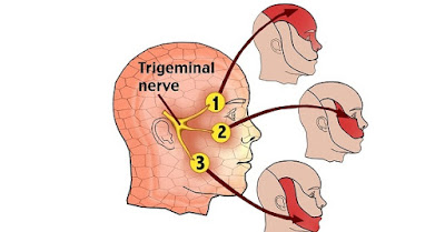 Tìm hiểu nguyên nhân đau dây thần kinh số 5