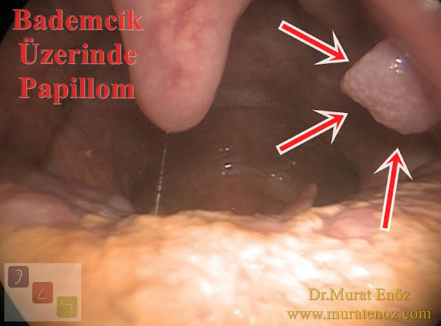 Bademcik papillomu - Bademcik üzerinde siğil - Boğazda siğil - Ağızda HPV enfeksiyonu - Bademcik papillomu foto