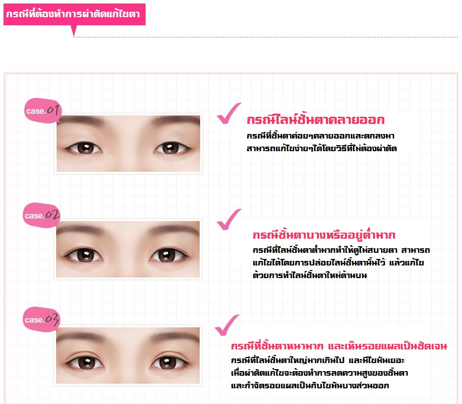 เพราะอะไรการทำตาถึงต้องแก้หลายครั้ง แก้ตาแบบเกาหลีที่ครั้งเดียวจบเค้ามีวิธีแก้ไขอย่างไร?