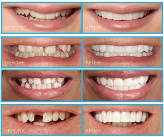 snap on smile cost snap on smile cost