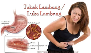 Fungsi Obat Ranitidin Untuk Kesehatan